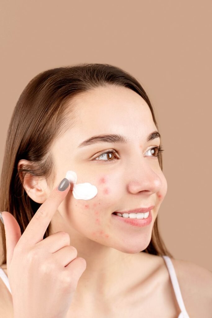 Young woman applying acne treatment cream to her skin