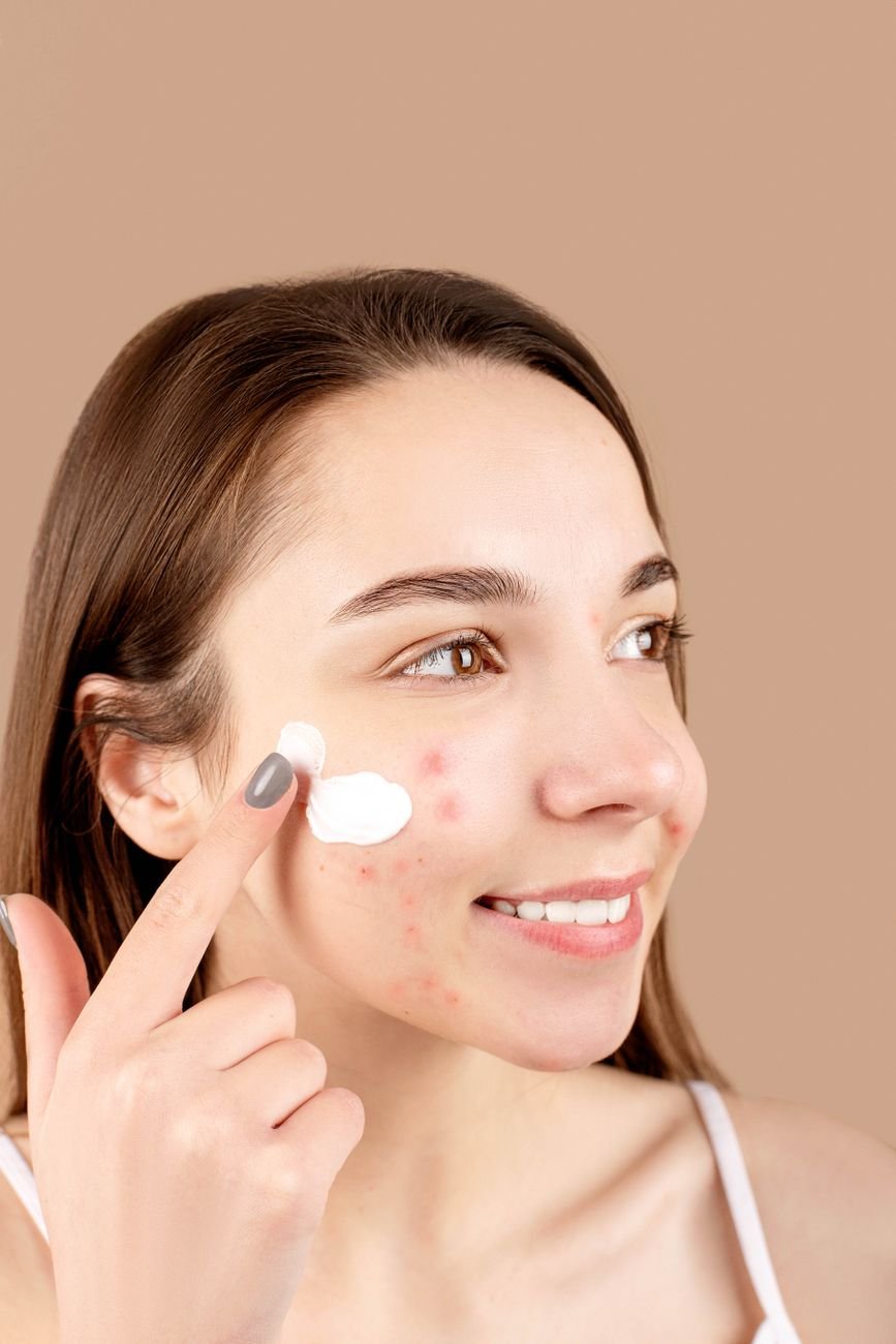 Young woman applying acne treatment cream to her skin