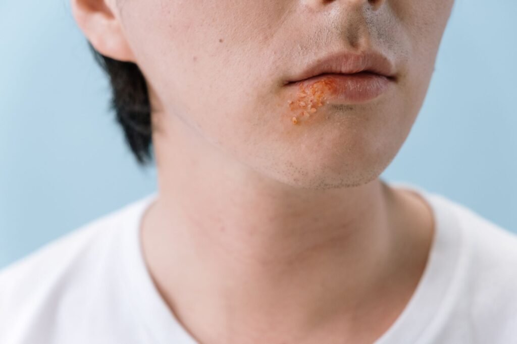 Close-up of a cold sore on the lower lip
